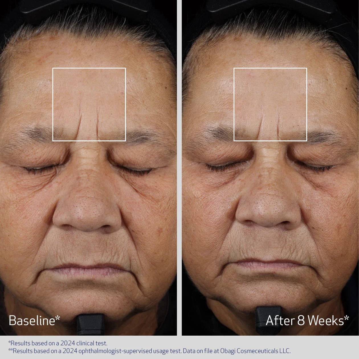 Elastiderm Advanced Filler Concentrate