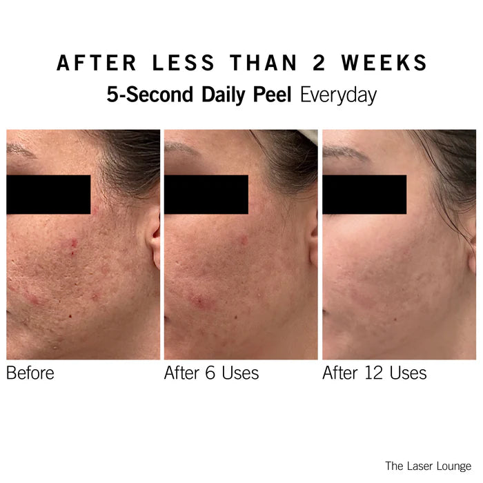 5 Second Daily Peel
