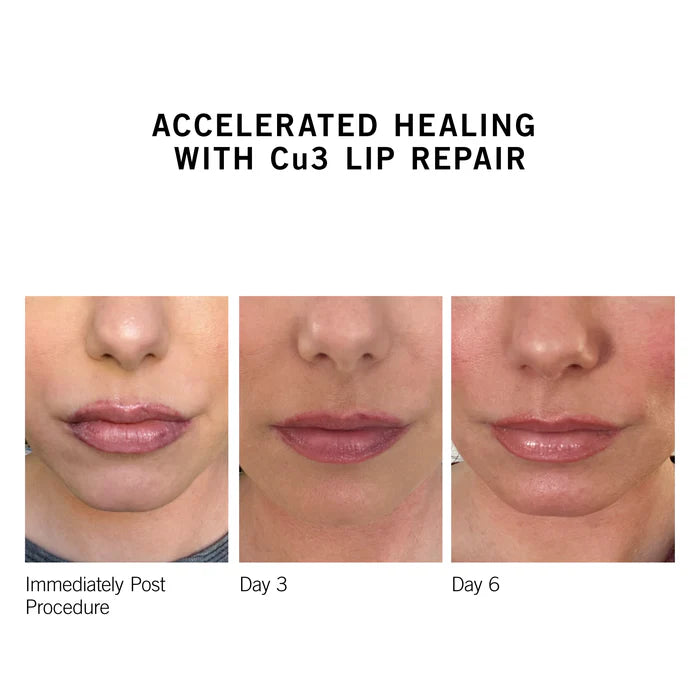 CU3 Lip Repair